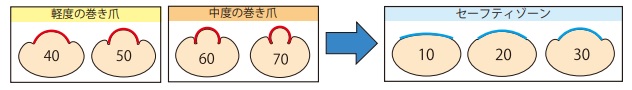 巻き爪補正図